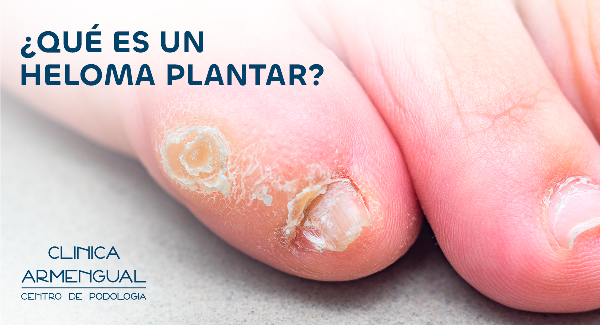 Heloma plantar - Clinica armengual malaga